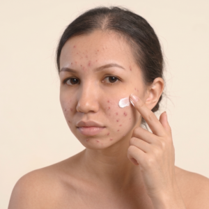 Spot Treatment