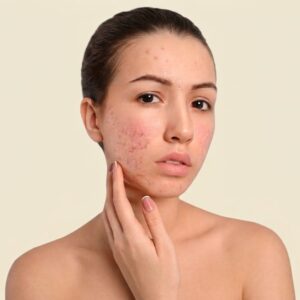Acne Treatment
