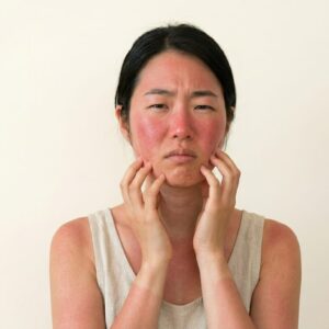 Sun Burn Treatment